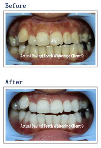 davinci cosmetic teeth whitening