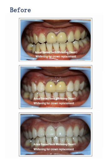 reviews on davinci teeth whitening