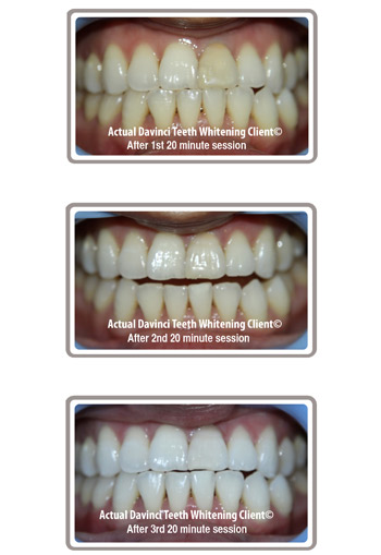 zoom vs. davinci teeth whitening