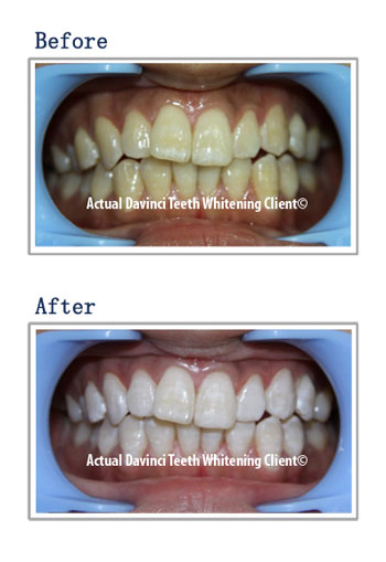 Before and After Gallery - DaVinci Teeth Whitening Systems, Parker Colorado