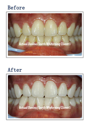 Before and After Gallery - DaVinci Teeth Whitening Systems, Parker Colorado